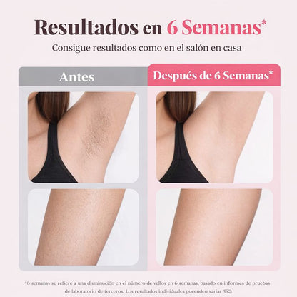 IPL Hair Reduction Device